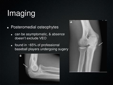 PPT - Medial Elbow Instability PowerPoint Presentation ...