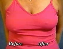 There are various breast lift techniques offered. How much would a breast lift surgery cost you? - Quora