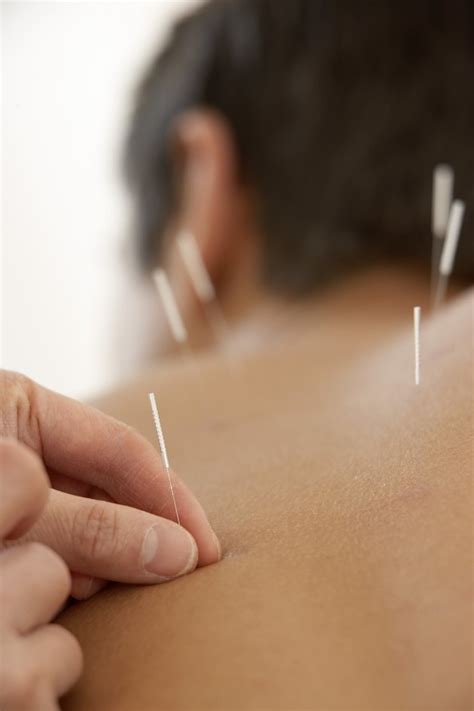 Each acupuncture point has a different therapeutic effect. Is Bruising Normal With Acupuncture Treatments ...