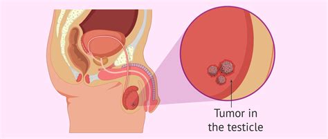 Testicular cancer is a disease in which malignant (cancer) cells form in the tissues of one or both testicles. Testicular Cancer
