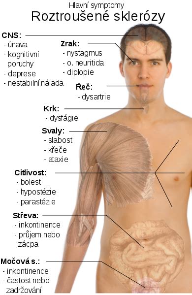 Toto onemocnění postihuje centrální nervový systém. Inovace jsou IN