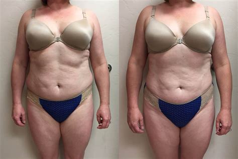 Maybe you would like to learn more about one of these? Before and After | Liposuction | Plastic Surgery