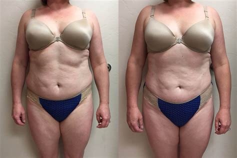 Reconstructive surgery and cosmetic surgery. Before and After | Liposuction | Plastic Surgery