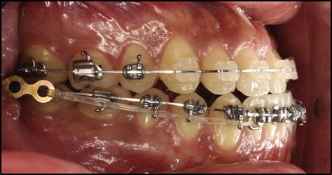 Distalization of the mandibular dentition with a ramal ...