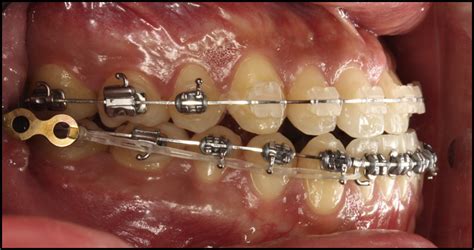 His research project was published in the american journal of. Distalization of the mandibular dentition with a ramal ...