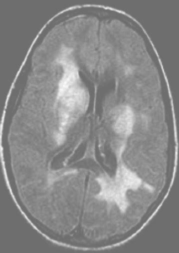 Traducir encefalomielitis significado encefalomielitis traducción de encefalomielitis sinónimos de encefalomielitis, antónimos de encefalomielitis. ENCEFALOMIELITIS DISEMINADA AGUDA PDF