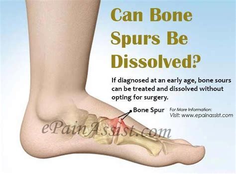 As we age, we develop wear and tear of all of our joints, including in our feet and toes. Pin on back pain relief