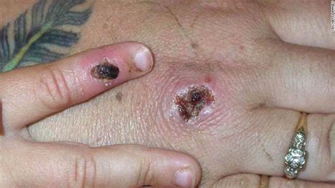 Monkeypox is an orthopox virus that was recognized in 1958 in laboratory monkeys and found to cause human infection in 1970 by the world health organization ( . Monkeypox: Third case reported in the UK, in healthcare ...