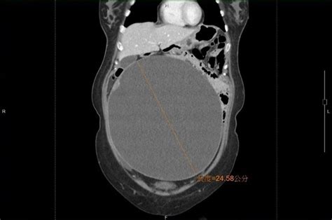 員工報到及離職專區 員工消費合作社 員工入口網 人事服務網ecpa 中榮通報系統 8585員工心理諮商輔導 部定專科住院醫師專區 中榮e學網 中榮e學網(院. 未婚女肚子脹大如懷孕!剖開驚見「24公分巨球」…醫：患者通常無症狀 | ETtoday健康 | ETtoday新聞雲
