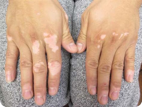 Pityriasis versicolor is a common skin complaint in which flaky discoloured patches appear mainly on the chest and back. White Lesions on the Hands and Lower Extremities - Photo ...