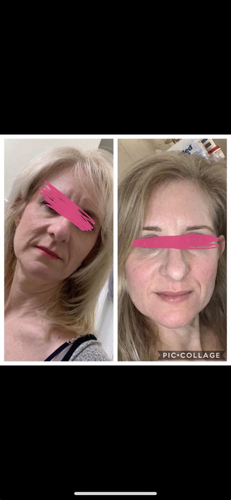 Jul 01, 2021 · r/tretinoin: Before and After : tretinoin