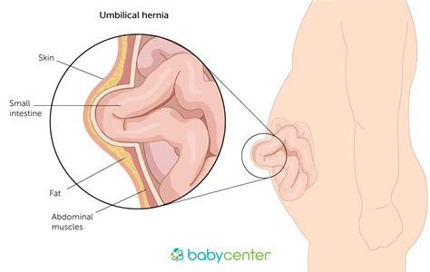 An umbilical hernia forms at the belly button, or the umbilicus. Hernias | BabyCenter
