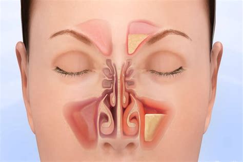 First, you're trepidatious about how you want to approach it, but go in with good intentions and excitement at the prospect of a new connection or opportunity. What is Sinus Infection? - Definition, Symptoms, Treatment