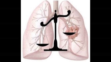 Check spelling or type a new query. mesothelioma xray - YouTube