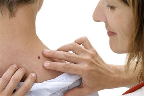 Squamous cell carcinoma is the second most common form of skin cancer. Skin Cancer Quick Facts