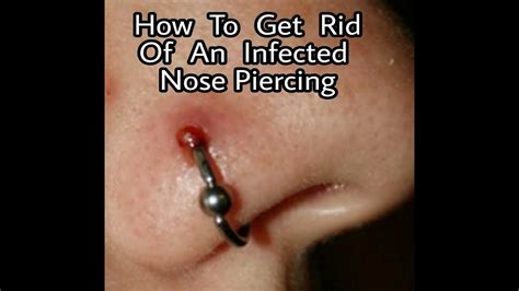 Is it red, extremely swollen, or thick yellow or green pus oozing from it? How To Get Rid Of A Nose Piercing Infection FAST | GROSS ...