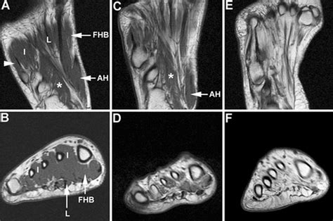 Indications for foot mri scan. МРТ стопы, что показывает 🚩 как проходит, сколько длится ...