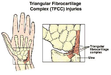 Discus triangularis oder discus articularis ulnocarpalis) ist beim menschen eine dreieckig geformte, aus faserknorpel bestehende zwischengelenksscheibe am handgelenk. What is the Triangular Fibrocartilage Complex (TFCC ...