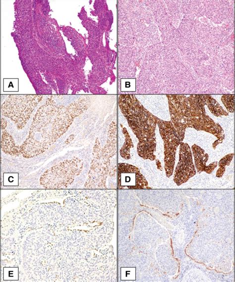 ALK/EML4 Fusion Gene May Be Found in Pure Squamous ...