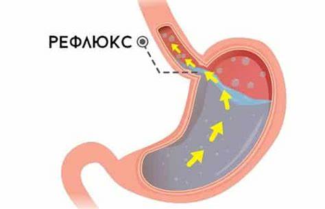 Рефлюкс гастрит диета лечение Рефлюкс-гастрит: виды, симптомы, диета и лечение Рефлюкс-гастрит: виды, симптомы, диета и лечение Рефлюкс гастрит диета лечение
