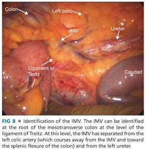 The suspensory muscle of duodenum is a thin muscle connecting the junction between the duodenum, jejunum, and duodenojejunal flexure to connective tissue surrounding the superior mesenteric artery and coeliac artery. Low Anterior Resection: Hand-Assisted Laparoscopic Surgery ...