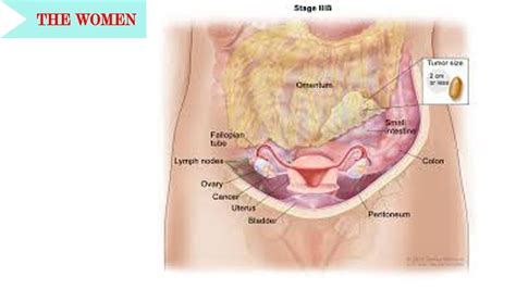 Researches have shown that women with pcos have a high risk of ovarian cancer; Colon Cancer in Ovaries Versus Ovarian Cancer|| General ...