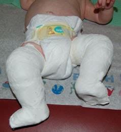 Posted by admin on november 22. Club Foot: Treatment Options For Your Baby