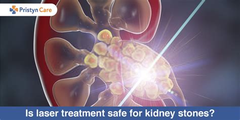 How long did it take jaime? How Long Does It Take To Pass Kidney Stones After Laser ...
