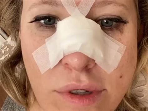 Собчак шокировала кривым носом после операции (фото)