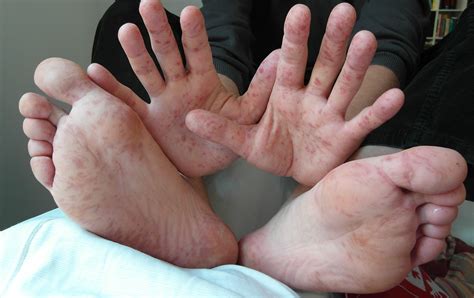 The cause of hand, foot and mouth disease is coxsackievirus a type 16 in most cases, but the infection can also be caused by many other strains of coxsackievirus. Colloidal Silver for Hand, Foot, and Mouth Disease
