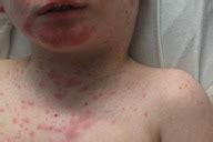 Herpes is an infection that is caused by a herpes simplex virus (hsv). A case of Drug Rash with Eosinophilia and Systemic ...