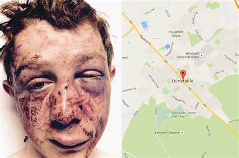 Horrifying pictures show lad's injuries after being kicked ...