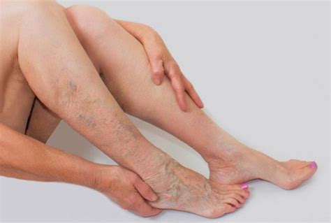 Eine thrombose ist das resultat eines blutgerinnsels in einem gefäß. Doenças Vasculares | Tratamento vascular | SP | Steticlin