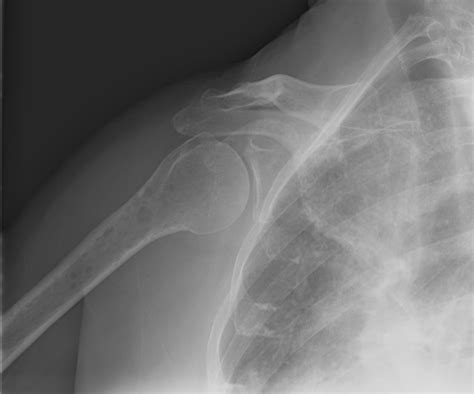 When they spread, they can cause you to feel shoulder pain. Shoulder pain in a patient with cancer — NUEM Blog