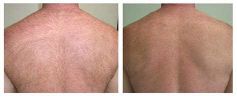 An electrical current passes through it, which heats up the tissue surrounding the hair follicle. Before and After | Renova Laser Hair Removal & MedSpa ...