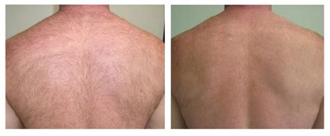 Before and after pictures are the favorite tool of countless doctors to show off their techniques and skills. Before and After | Renova Laser Hair Removal & MedSpa ...