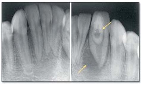 Figure 3 from Dens invaginatus on a geminated tooth: a case report ...