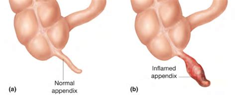 Waaraan kun je een blindedarmontsteking herkennen? Appendicitis - Pictures, Signs, Symptoms, Causes ...