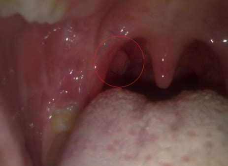 Or the cancer could release substances that change the way the body makes energy. Throat Archives - How To Cure Fast
