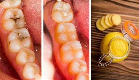 Apakah yang menyebabkan gejala sakit gigi? Buat Kamu yang Giginya Berlubang dan Sering Sakit Gigi ...