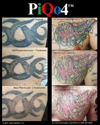 Tattoo ink is removed by using a specific wavelength of light which passes through the skin but is absorbed by the ink. First Tattoo Studio in Existence to Feature the New PiQo4 ...