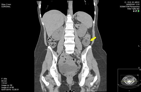 Want to learn more about it? A rare case of adult colocolonic intussusception of the ...