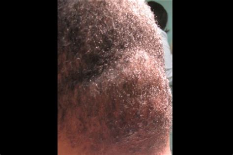 Derm Dx: A large mass on the scalp - Clinical Advisor