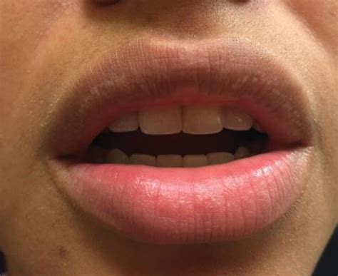 Mouth sores and spots can be painful, unsightly, and annoying and while some may appear inside the mouth such as one lips, tongue, gums, and roof of. Small White Spots on the Lips | MDedge Dermatology