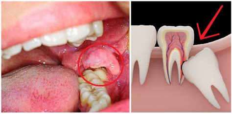 Gigi geraham atas kanan dengan kondisi periodontitis kronis,disini bisa ditandai dengan kondisi gigi nya yang sudah tidak. Inilah yang Harus Segera Anda Lakukan Ketika Tumbuhnya ...