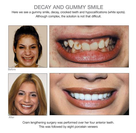 Are you uncertain of how to fix crooked teeth and where to get veneers in los angeles? How To Fix A Crooked Smile Without Surgery - Bmoshow Blog