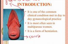 uterine prolapse ulcer obstetrics