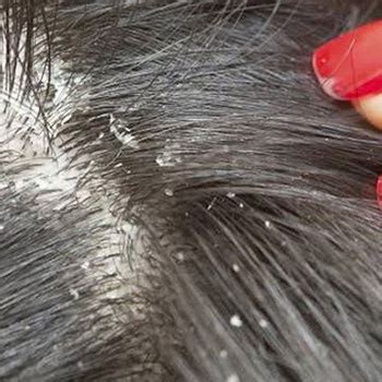 Demodex mites live in our hair follicles as they thrive on the nutrition on our hair as one of their primary food sources. Demodex Hair Tonic | Ungex Demodex Mite Solutions Scalp ...