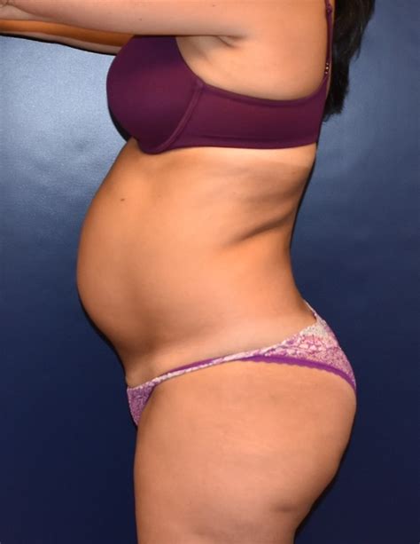 What is jen richards marital status ? Tummy Tuck Before and After Photos by Richard Reish, MD ...