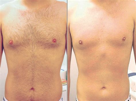 Hair typically grows all over the human body. Body Hair Removal Philadelphia - Back hair removal for men